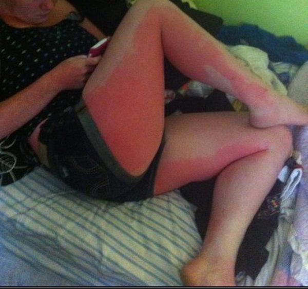 a-friendly-and-painful-reminder-to-wear-sunscreen-this-weekend-27-photos-11