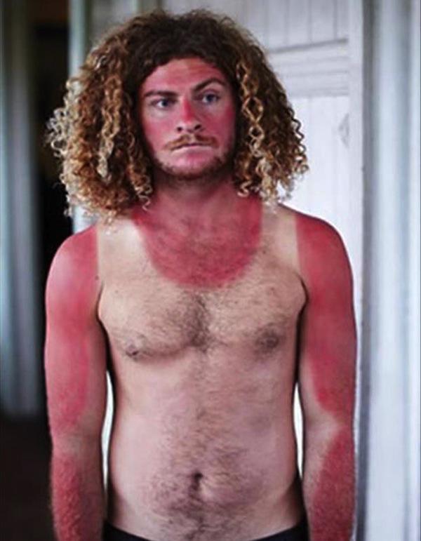 a-friendly-and-painful-reminder-to-wear-sunscreen-this-weekend-27-photos-16