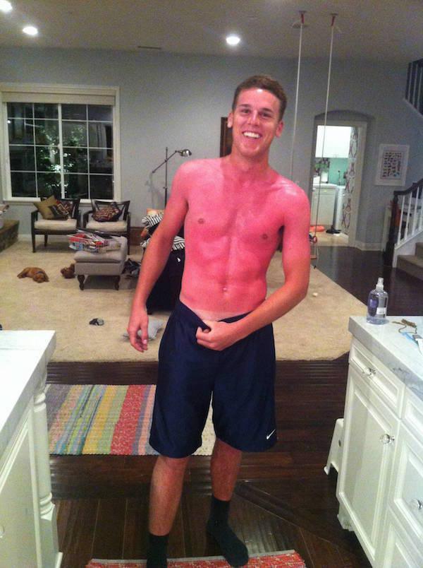 a-friendly-and-painful-reminder-to-wear-sunscreen-this-weekend-27-photos-19
