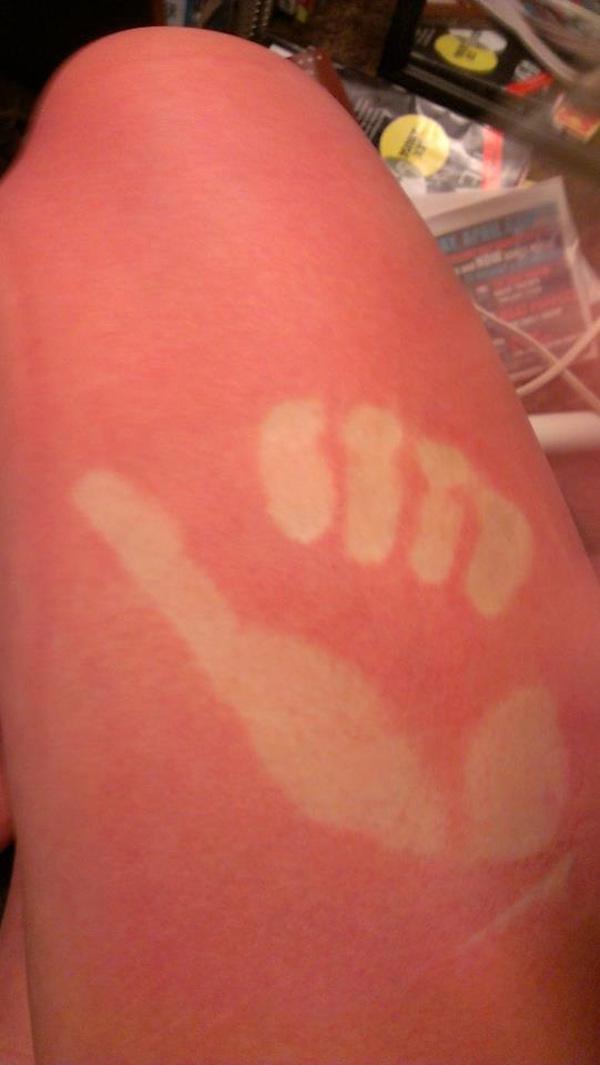 a-friendly-and-painful-reminder-to-wear-sunscreen-this-weekend-27-photos-2