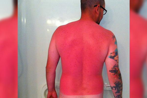 a-friendly-and-painful-reminder-to-wear-sunscreen-this-weekend-27-photos-28